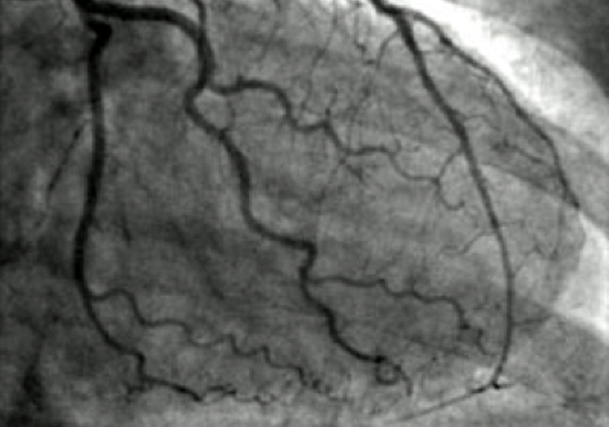 Diagnostic Coronary Angiogram Melbourne Cardiovascular And Diabetes Centre